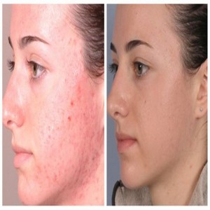 حار بيع Microdermabrasion الماس آلة تقشير الجمال مصنع البيع المباشر