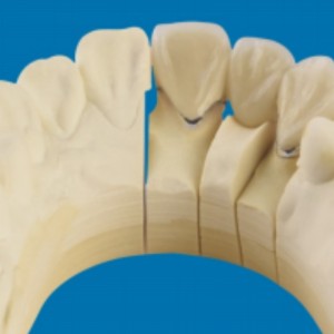 معدن-أسنان الخزف